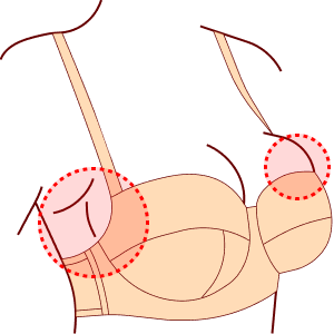 Косточки чашечек бюстгальтера упираются в грудь возле подмышки